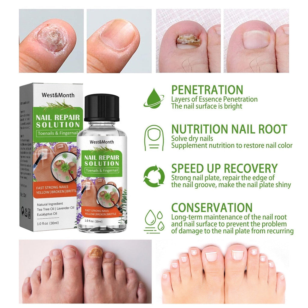 Lotion antifongique pour ongles